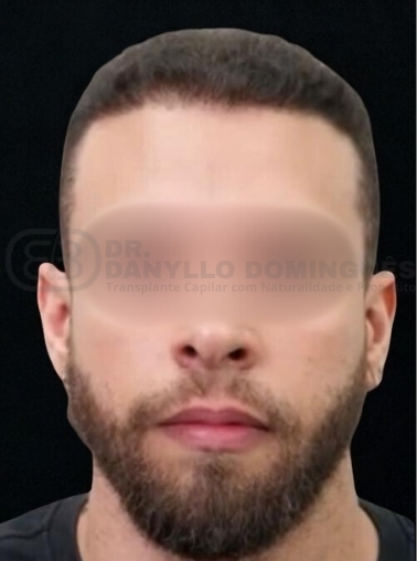 1 ANO PÓS OPERATÓRIO