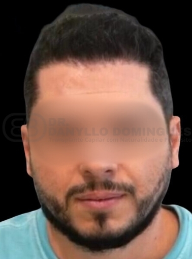1 ANO PÓS OPERATÓRIO
